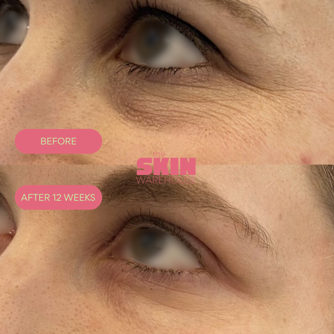 RF Eye Lift Pro